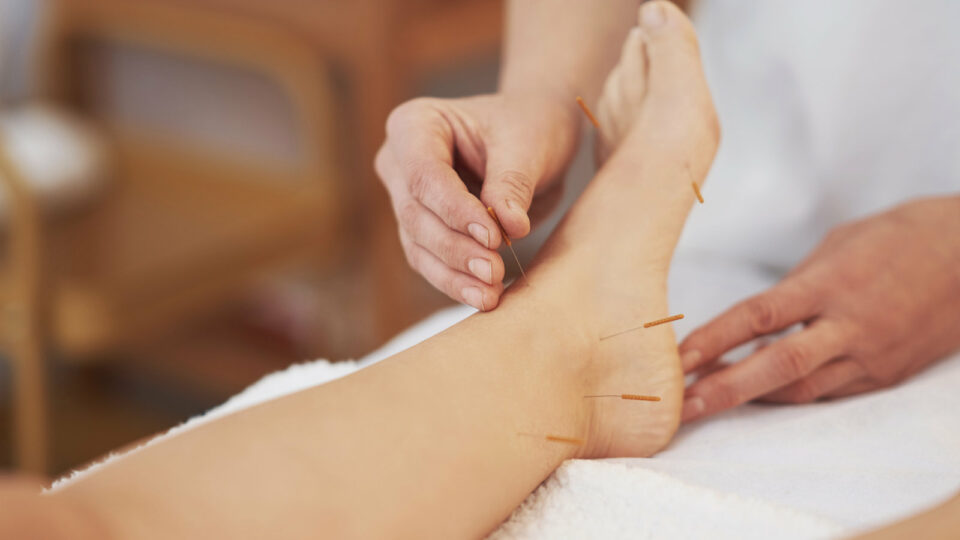 6 Great Benefits of Acupuncture for Runners Great Benefits of Acupuncture for Runners